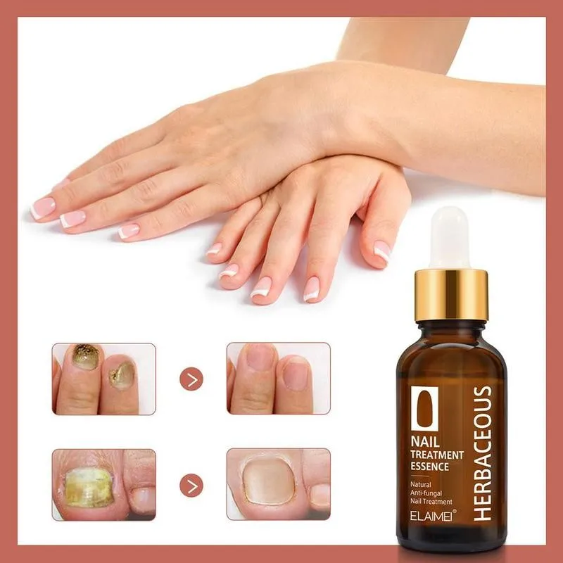 Nail Fungal Treatment Anti-fungal Toe Nail Fungus Removal 30ml Onychomycosis Gel Remove Antibacterial Nail Care Serum Liqui Q8G1 
Nail Fungal Treatment Anti-fungal Toe Nail Fungus Removal 30ml Onychomycosis Gel Remove Antibacterial Nail Care Serum Liqui Q8G1
