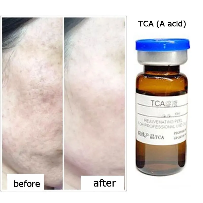 TCA Professional grade A acid peeling removes tattoo age spots stretch marks AHA skin rejuvenation Acne pit Spot coating 10ml
TCA Professional grade A acid peeling removes tattoo age spots stretch marks AHA skin rejuvenation Acne pit Spot coating 10ml