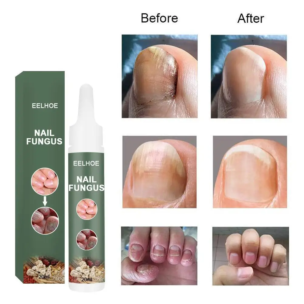 20ml Effective Fungal Nail Treatments Essences Serum Onychomycosis Paronychia Anti-Fungal Nail Infective From Nail Fungus Foot
20ml Effective Fungal Nail Treatments Essences Serum Onychomycosis Paronychia Anti-Fungal Nail Infective From Nail Fungus Foot