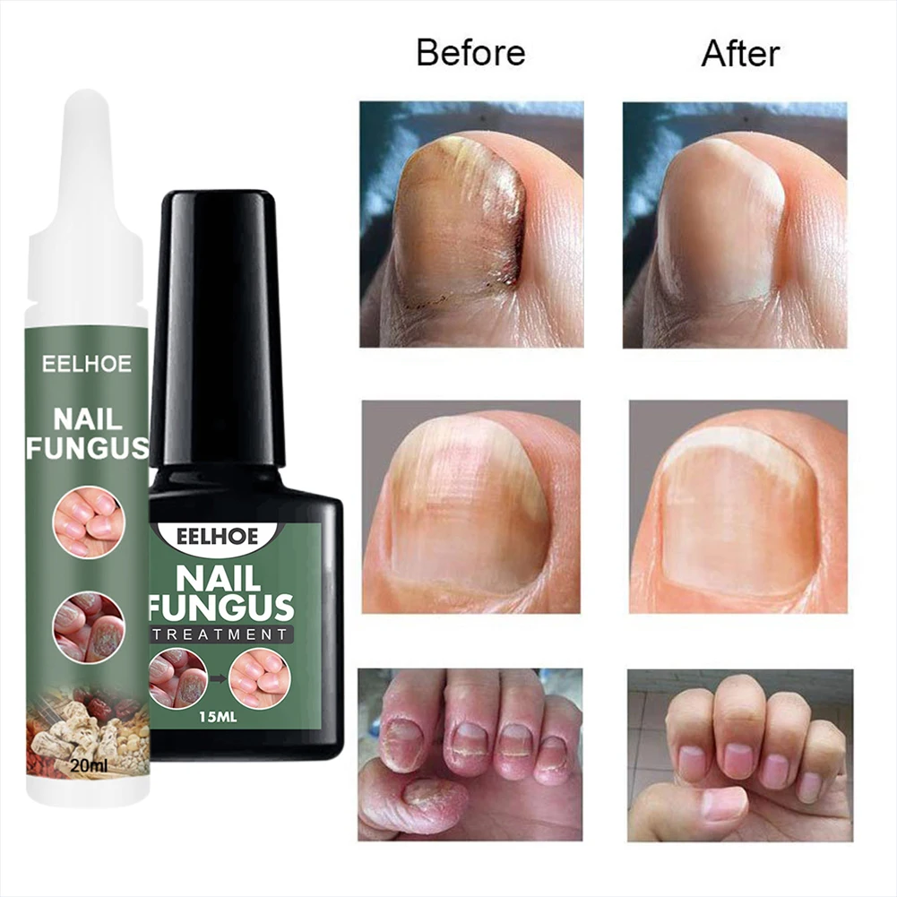Nail Fungal Cure Nail Fungus Removal Liquid Nutritious Anti Nail Fungus Treatment Foot Repair Fungal Nail Repair Toenails
Nail Fungal Cure Nail Fungus Removal Liquid Nutritious Anti Nail Fungus Treatment Foot Repair Fungal Nail Repair Toenails
