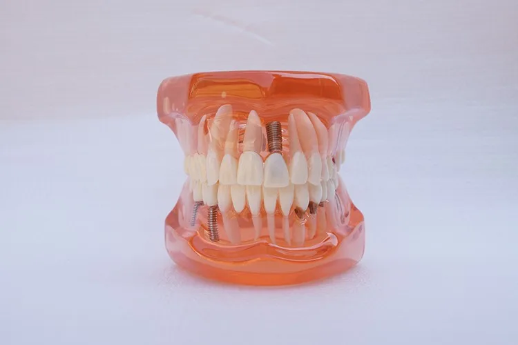 

1 шт. зубной имплантат заболеваний зубов Модель с восстановлением мост зуб для медицинский стоматолог обучения или профессиональной подгот...