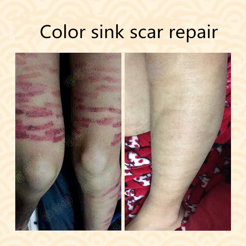 Combination of scar removing and repairing fluid and cream, desalt scald, repair of scar with melanin, pockmark mark
Combination of scar removing and repairing fluid and cream, desalt scald, repair of scar with melanin, pockmark mark