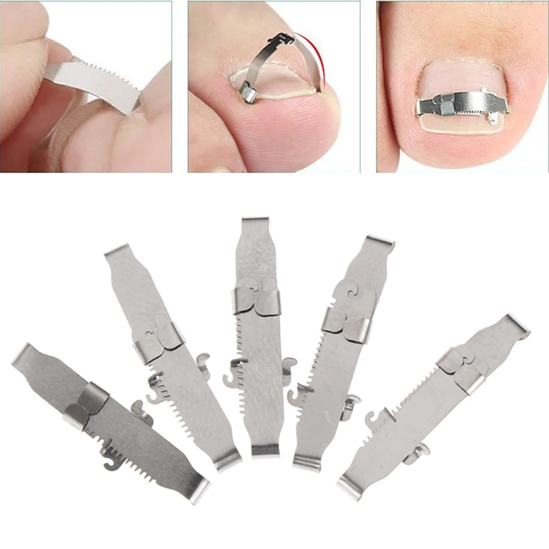 Ingrown Toenail Corrector Orthotic Nail Fixer Toenail Correction Treatment Foot Care Tools Recover Embed Tool Corrector Pedicure
Ingrown Toenail Corrector Orthotic Nail Fixer Toenail Correction Treatment Foot Care Tools Recover Embed Tool Corrector Pedicure