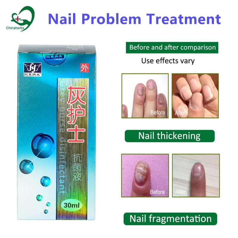 1 Bottle Antibacterial Fungus Nail Treatment Cream Onychomycosis Paronychia Infection Antibacterial Solution
1 Bottle Antibacterial Fungus Nail Treatment Cream Onychomycosis Paronychia Infection Antibacterial Solution