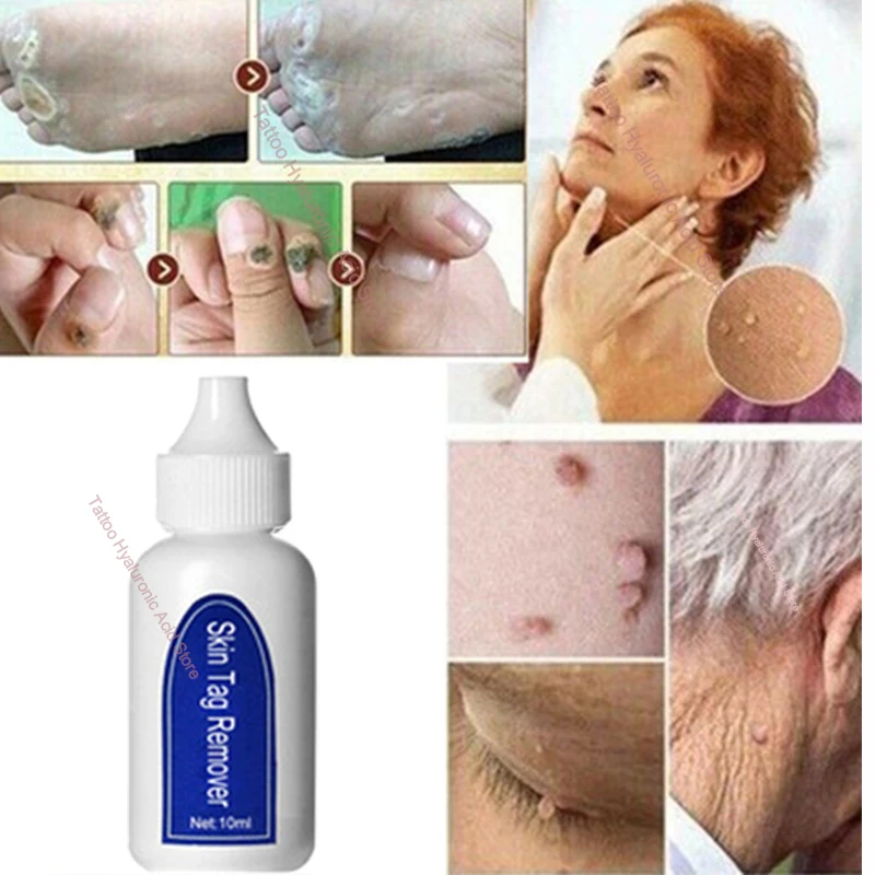 New listing Skin Tag Remover Genital Wart Treatment Removal Mole & Papillomas Foot Corn Repair Tool Natural Bacteriostatic 2021
New listing Skin Tag Remover Genital Wart Treatment Removal Mole & Papillomas Foot Corn Repair Tool Natural Bacteriostatic 2021