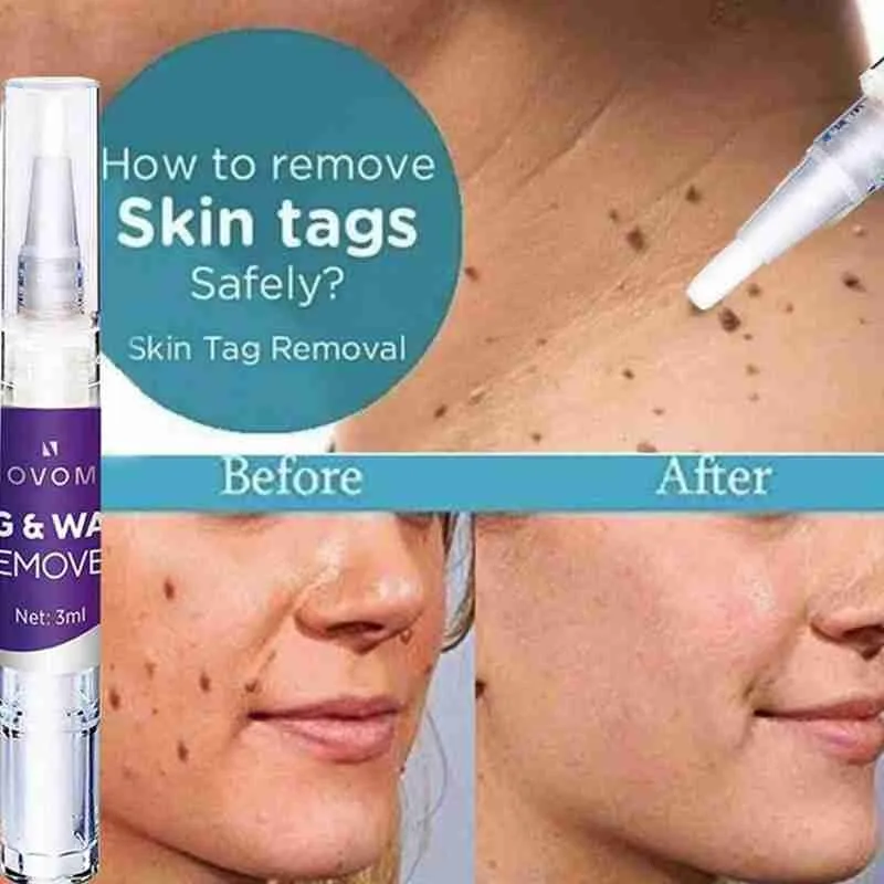 Skin Tag Remover Warts Remover Liquid Pen Wart Treatment Cream Herbal Extract Foot Corn Plaster Acne Warts Ointment Skin Care
Skin Tag Remover Warts Remover Liquid Pen Wart Treatment Cream Herbal Extract Foot Corn Plaster Acne Warts Ointment Skin Care