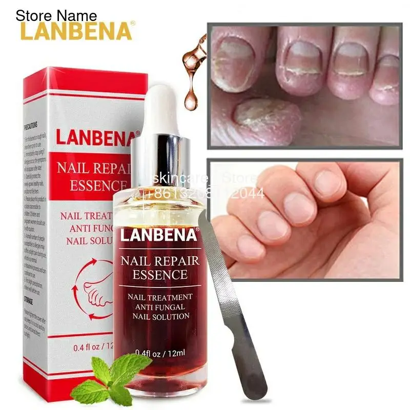 LANBENA Nail Repair Essence Serum Fungus Removal Gel Anti Infection Paronychia Onychomycosis Hand Foot Nails Treatment Skin Care
LANBENA Nail Repair Essence Serum Fungus Removal Gel Anti Infection Paronychia Onychomycosis Hand Foot Nails Treatment Skin Care