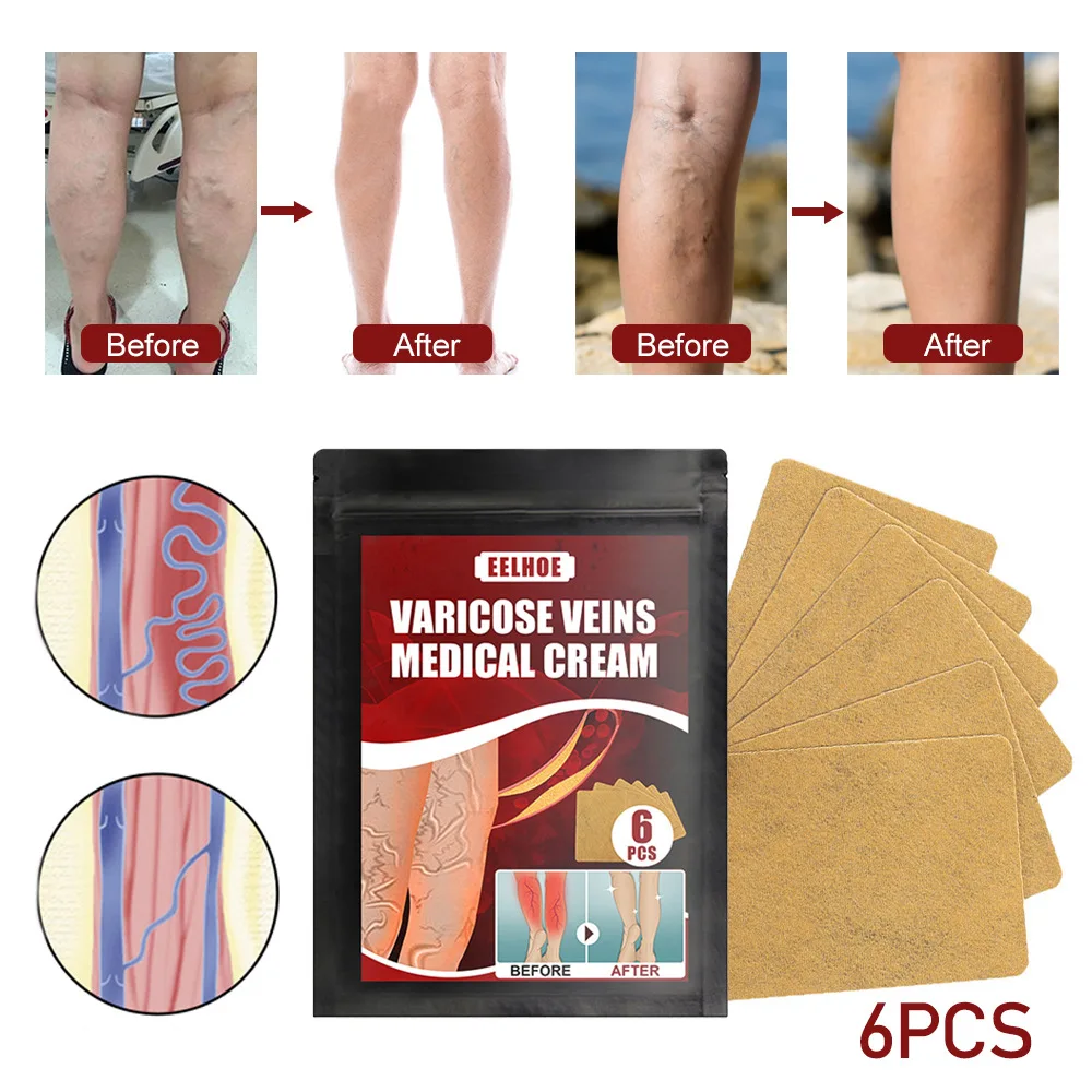 herbal varicose vein treatment varicose vein patch veinsimproves blood circulation and quickly relieves fatigue fashion
herbal varicose vein treatment varicose vein patch veinsimproves blood circulation and quickly relieves fatigue fashion