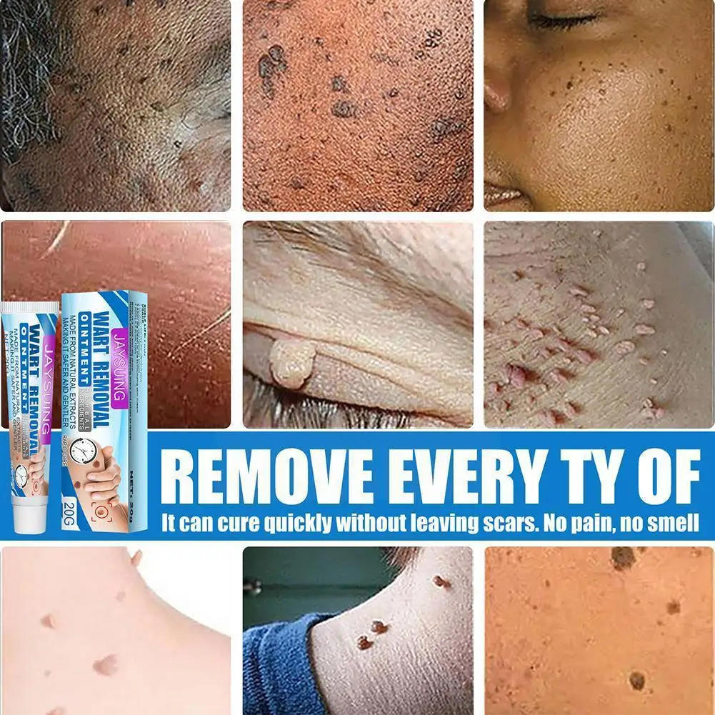20g Wart Removal Cream Skin Tag Remover Ointment Herbal Treatment Skin Warts Corn Mole Plaster Care Cream Extract B9M0
20g Wart Removal Cream Skin Tag Remover Ointment Herbal Treatment Skin Warts Corn Mole Plaster Care Cream Extract B9M0