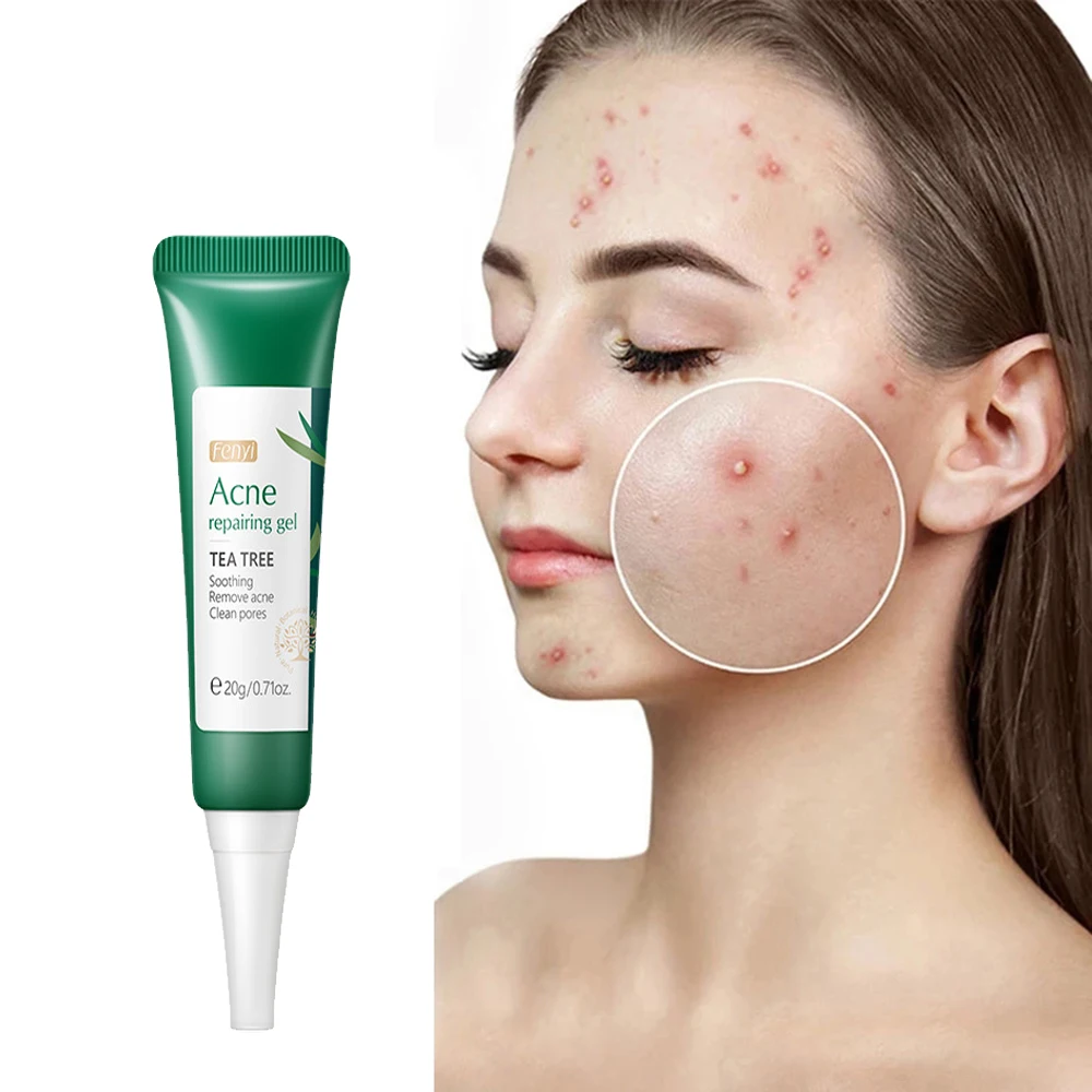 Tea Tree Acne Gel Reduces Acne Redness Shrink PoresSensitive Anti Inflammatory Acne Treatment Face Skin Care Cream Products
Tea Tree Acne Gel Reduces Acne Redness Shrink PoresSensitive Anti Inflammatory Acne Treatment Face Skin Care Cream Products