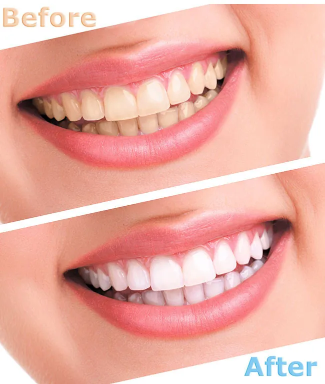 Teeth Whitening Kit with led light Dental Equipment 44% Peroxide Bleaching System Oral Gel Kit clareador dental gel pens
Teeth Whitening Kit with led light Dental Equipment 44% Peroxide Bleaching System Oral Gel Kit clareador dental gel pens