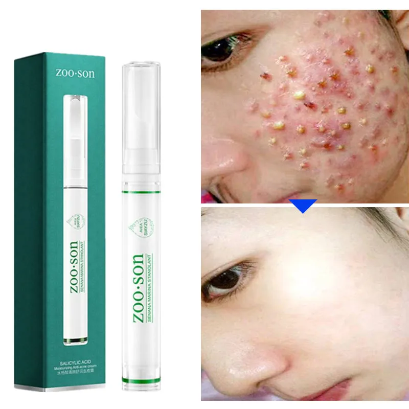 15g Salicylic acid Acne Treatment Blackhead Remova Anti Acne Cream Oil Control Shrink Pores Acne Scar Remove Face Care Whitening
15g Salicylic acid Acne Treatment Blackhead Remova Anti Acne Cream Oil Control Shrink Pores Acne Scar Remove Face Care Whitening