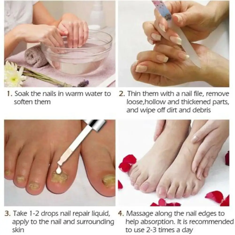 Nail Fungal Treatment Feet Care Essence Nail Foot Whitening Fungus Paronychia Toenail Anti Onychomycosis Removal Gel Infect D0R6
Nail Fungal Treatment Feet Care Essence Nail Foot Whitening Fungus Paronychia Toenail Anti Onychomycosis Removal Gel Infect D0R6