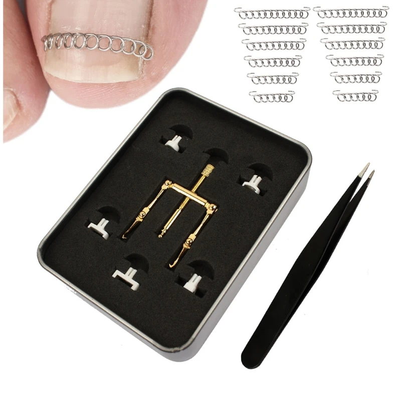 Ingrown Toenail Tools Kit Includes Ingrown Toenail Tool Toe Clamp Ingrown Toenail Corrector Headers Nail Retainers
Ingrown Toenail Tools Kit Includes Ingrown Toenail Tool Toe Clamp Ingrown Toenail Corrector Headers Nail Retainers
