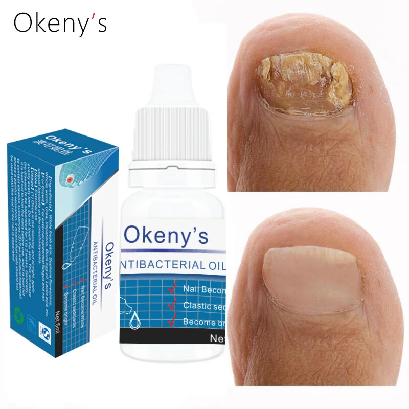 

Средство для лечения Ногтей от грибков Okeny, эссенция для ухода за ногами, антиинфекционный грибок паронихии для ногтей, сыворотка для удаления онихомикоза, 5 мл