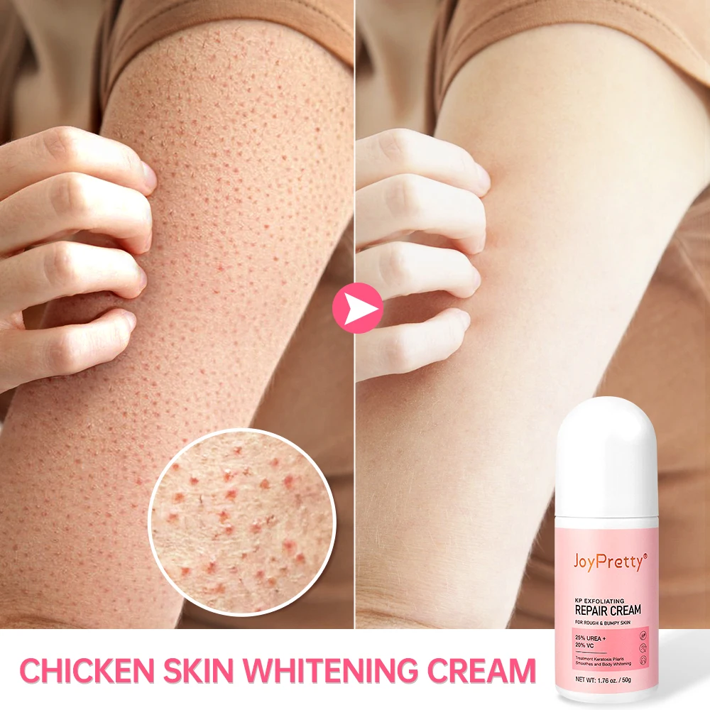 Joypretty Body Cream Whitening Chicken Skin Removal Treatment Keratosis Pilaris Lotion Pore Spot Care Smooth Moisturizer Creams
Joypretty Body Cream Whitening Chicken Skin Removal Treatment Keratosis Pilaris Lotion Pore Spot Care Smooth Moisturizer Creams