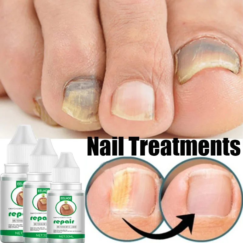 Nail Fungal Treatment Foot Care Essence Nail Foot Toe Nail Fungus Removal Gel Anti Infection Paronychia Onychomycosis 10/20/30ML
Nail Fungal Treatment Foot Care Essence Nail Foot Toe Nail Fungus Removal Gel Anti Infection Paronychia Onychomycosis 10/20/30ML