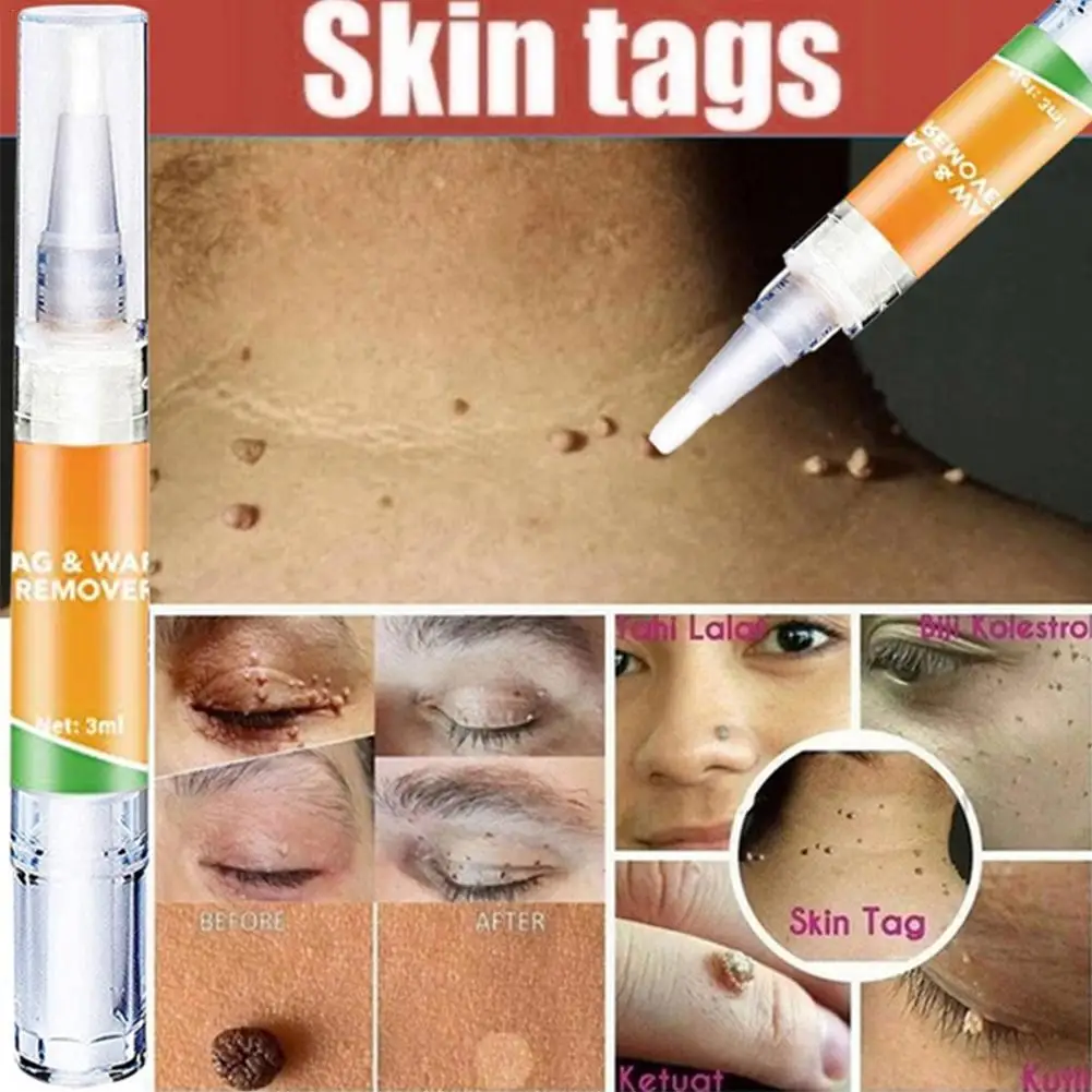 Wart Removal Mole Remedy Liquid Pen Herbal Painless Skin Tags Remover Serum For Acne Freckle Spot Treatment Beauty Health Care
Wart Removal Mole Remedy Liquid Pen Herbal Painless Skin Tags Remover Serum For Acne Freckle Spot Treatment Beauty Health Care