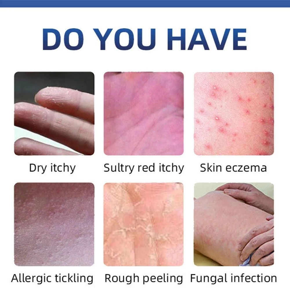 20g Treatment Skin Care Body Health Herbal Anti-itch Relief Antibacterial Cream Desquamation Psoriasis Ointment
20g Treatment Skin Care Body Health Herbal Anti-itch Relief Antibacterial Cream Desquamation Psoriasis Ointment