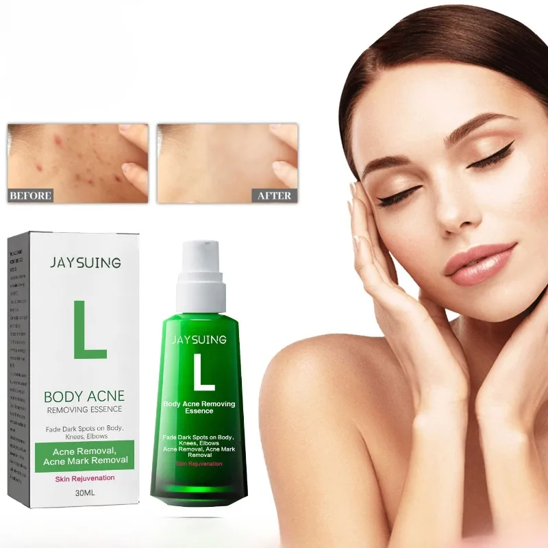 Whitening Remove Acne Serum Fade Freckles Dispelling Acne Marks Anti Body Pimple Moisture Smoothing Skin Spot Lightening Essence
Whitening Remove Acne Serum Fade Freckles Dispelling Acne Marks Anti Body Pimple Moisture Smoothing Skin Spot Lightening Essence