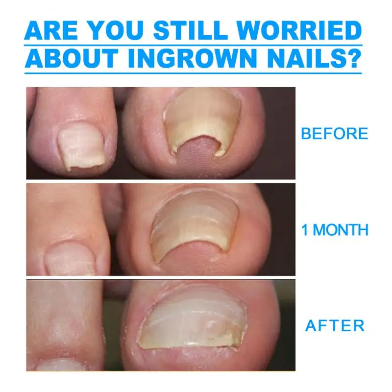 Nail Correction Stickers Ingrown Toenail Corrector Patches Paronychia Recover Corrector Pedicure Tools
Nail Correction Stickers Ingrown Toenail Corrector Patches Paronychia Recover Corrector Pedicure Tools