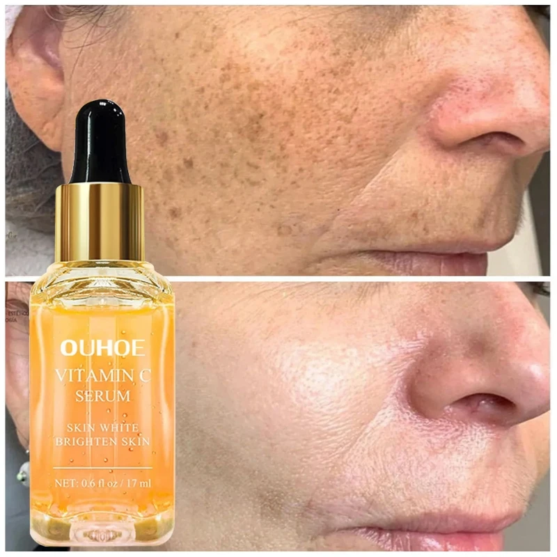 Vitamin C Freckles Face Serum Remove Dark Spots Freckles Fade Melanin Retinol Anti-wrinkle Essence Brightening Beauty Skin Care
Vitamin C Freckles Face Serum Remove Dark Spots Freckles Fade Melanin Retinol Anti-wrinkle Essence Brightening Beauty Skin Care