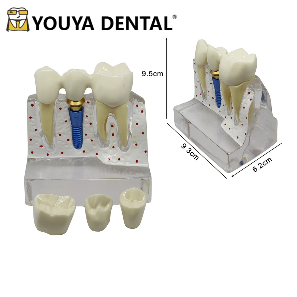 Dentist Teeth Teaching Model 4 Times Implant Model For Student Dentistry Clinics Demonstration Module Training Practice Modeling
Dentist Teeth Teaching Model 4 Times Implant Model For Student Dentistry Clinics Demonstration Module Training Practice Modeling