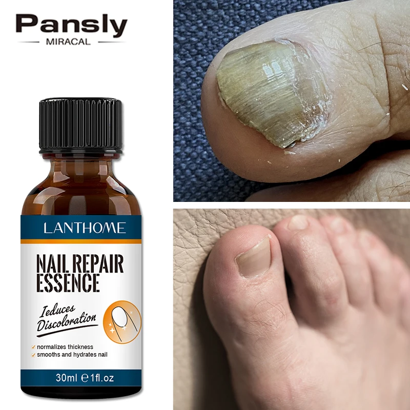 Toe Nail Fungal Effect Treatment Feet Care Essence Foot Repair Nail Fungus Remove Serum Gel Anti Infection Paronychia Onychomyco
Toe Nail Fungal Effect Treatment Feet Care Essence Foot Repair Nail Fungus Remove Serum Gel Anti Infection Paronychia Onychomyco