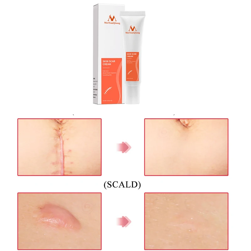 Acne Fade Scars Cream Skin Repair Face Cream Acne Spots Acne Treatment Blackhead Whitening Cream Anti Scar Stretch Marks 15g
Acne Fade Scars Cream Skin Repair Face Cream Acne Spots Acne Treatment Blackhead Whitening Cream Anti Scar Stretch Marks 15g