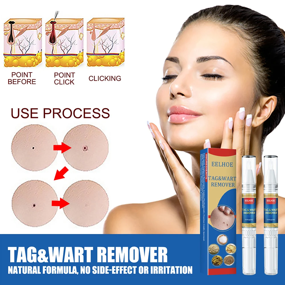 Removing Against Moles Liquid Pen Fast Drying Quickly Remove Skin Tags Wart Callus Natural Wart Removal Pen For All Skin Types
Removing Against Moles Liquid Pen Fast Drying Quickly Remove Skin Tags Wart Callus Natural Wart Removal Pen For All Skin Types