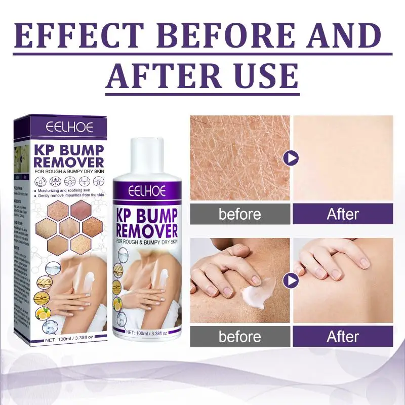 Whole Body Skin Acne Treatments Cream Clearing Buttock Thigh Acne Bumps Dark Spots Moisturizing Smoothing Hydrating Skin Care
Whole Body Skin Acne Treatments Cream Clearing Buttock Thigh Acne Bumps Dark Spots Moisturizing Smoothing Hydrating Skin Care