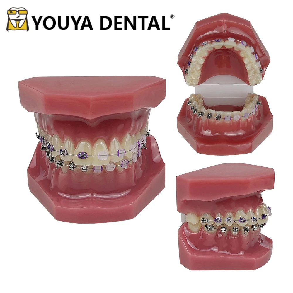 

Orthodontic Tooth Practice Model with Metal & Ceramic & Self-locking for Orthodontic Treatment Doctor-patient Communication Tool