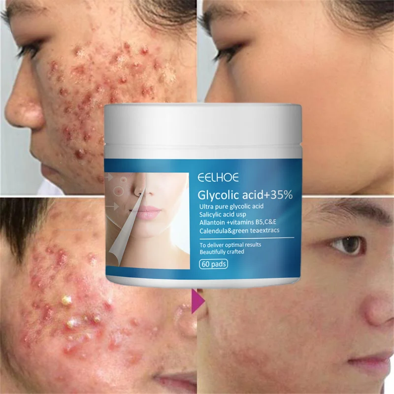 Glycolic Acid Gasket Acne Treatment Remove Dark Spot Pimples Anti-Wrinkle Clean Shrink Pores Serum Whiten Moisturizing Skin Care
Glycolic Acid Gasket Acne Treatment Remove Dark Spot Pimples Anti-Wrinkle Clean Shrink Pores Serum Whiten Moisturizing Skin Care