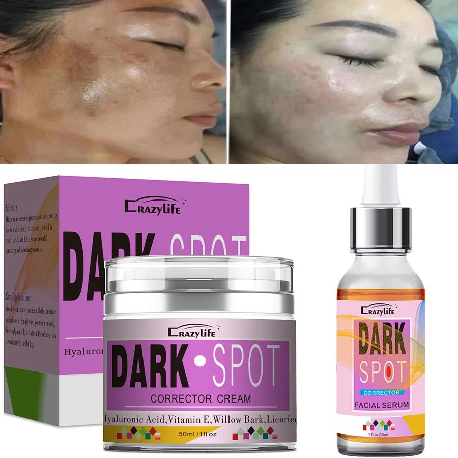 50ml Powerful Whitening Freckle Cream Remove Acne Spots Melanin Dark Spots Face Lift Firming Face Skin Care Beauty Essentials
50ml Powerful Whitening Freckle Cream Remove Acne Spots Melanin Dark Spots Face Lift Firming Face Skin Care Beauty Essentials