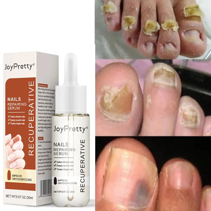 Nail Fungus Treatment Essence Serum Care Hand and Foot Care Removal Anti-infective Paronychia Onychomycosis Repair
Nail Fungus Treatment Essence Serum Care Hand and Foot Care Removal Anti-infective Paronychia Onychomycosis Repair