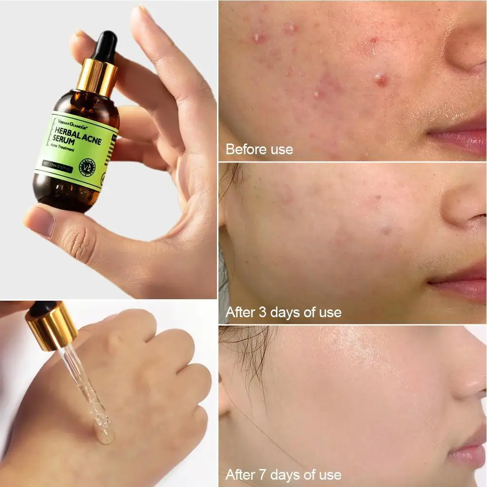 VIBRANT GLAMOUR Herbal Acne Treatment Serum Oil Control Brighten Firming Pores For Acne-prone Skin Essence Women Skin Care 17ml
VIBRANT GLAMOUR Herbal Acne Treatment Serum Oil Control Brighten Firming Pores For Acne-prone Skin Essence Women Skin Care 17ml