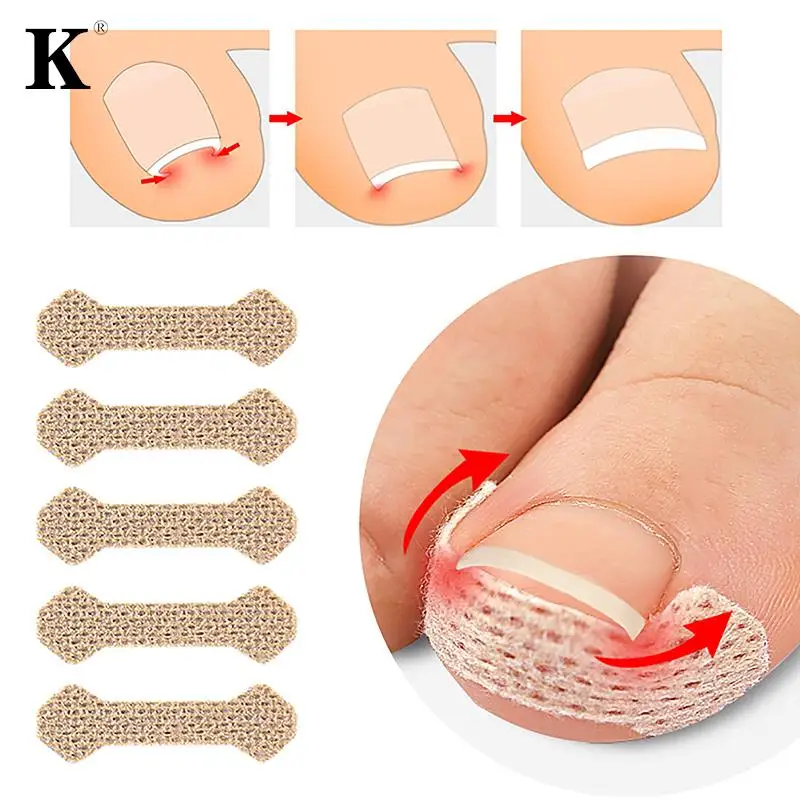 10Pcs/1pcs Nail Correction Stickers Ingrown Toenail Corrector Patches Paronychia Treatment Recover Corrector Pedicure Tools
10Pcs/1pcs Nail Correction Stickers Ingrown Toenail Corrector Patches Paronychia Treatment Recover Corrector Pedicure Tools