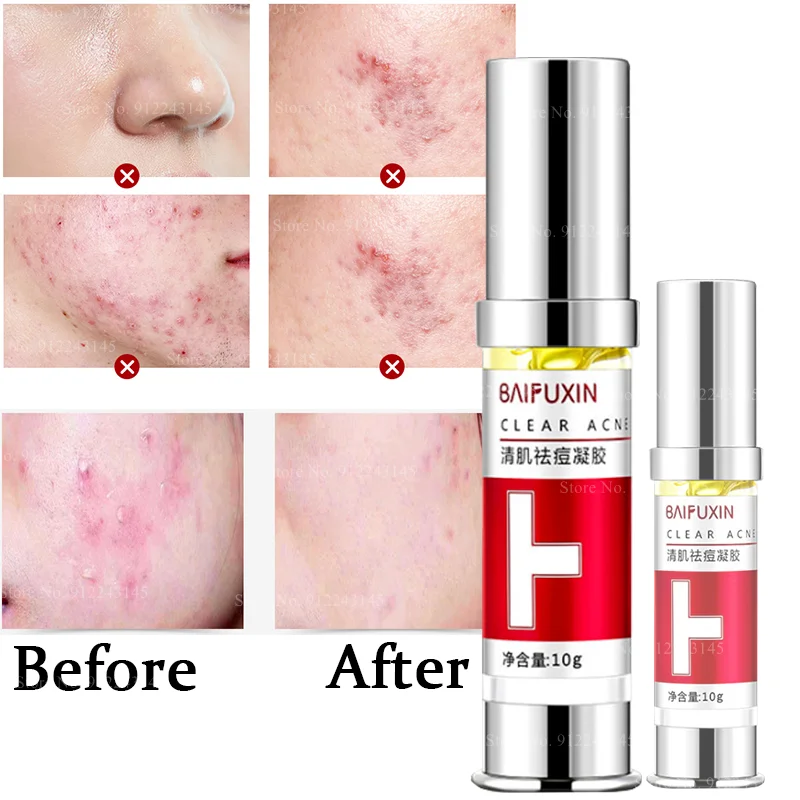 New Clean Up Skin Clear Closed Acne Acne Fade Acne Marks Repair Essence Gel Acne Gel Acne Cream Facial Care Skin Whitening
New Clean Up Skin Clear Closed Acne Acne Fade Acne Marks Repair Essence Gel Acne Gel Acne Cream Facial Care Skin Whitening