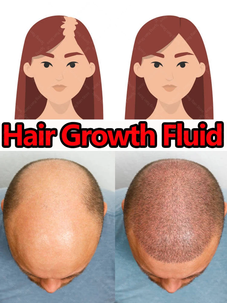 Раствор для роста волос Seborrheic Alopecia Hairline, средство для лечения волосяных фолликулов после родов
Раствор для роста волос Seborrheic Alopecia Hairline, средство для лечения волосяных фолликулов после родов
