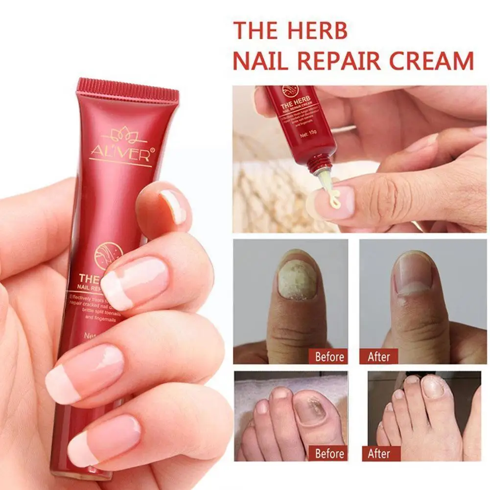 15ml Aliver Nail Fungus Treatment Herb Nails Repair Nail Cream Skin Tools Care Care Cream Onychomycosisnail Protector F5u8
15ml Aliver Nail Fungus Treatment Herb Nails Repair Nail Cream Skin Tools Care Care Cream Onychomycosisnail Protector F5u8