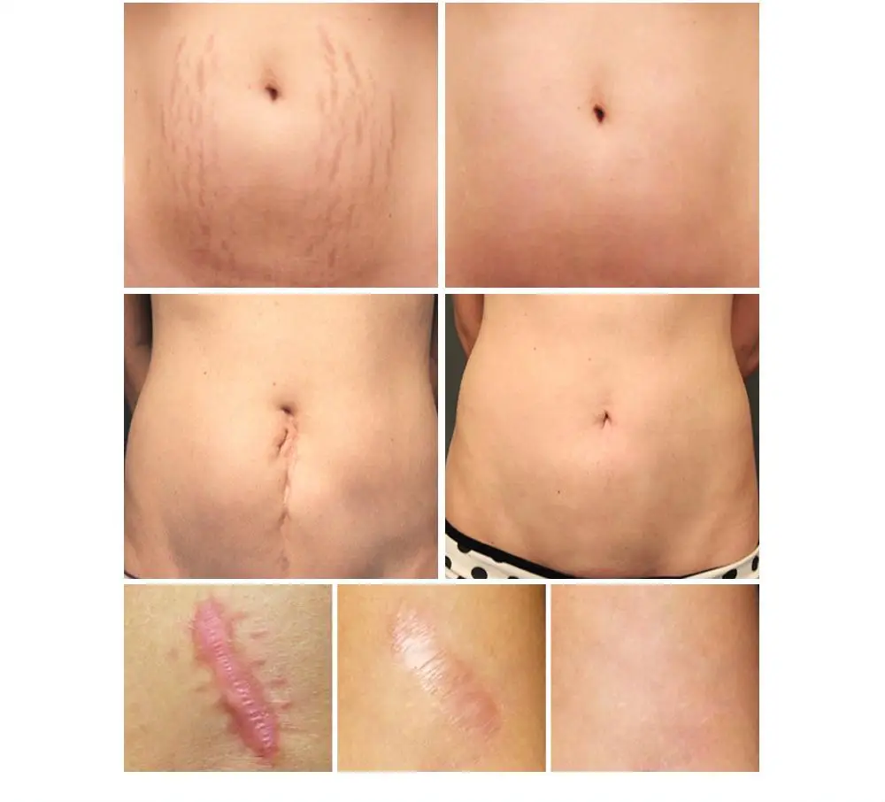 1-5 шт. 30 г крем для удаления шрамов от угрей и прыщей 
1-5 шт. 30 г крем для удаления шрамов от угрей и прыщей