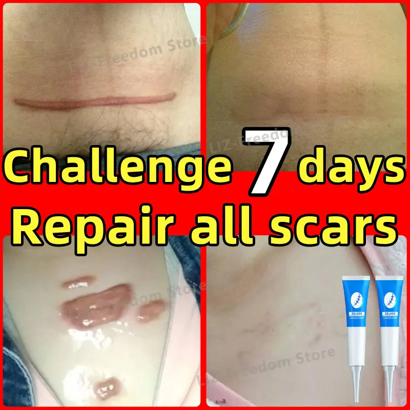 

Scar repair gel fades scars burns burns cesarean section stretch marks acne pits acne marks surgical scars