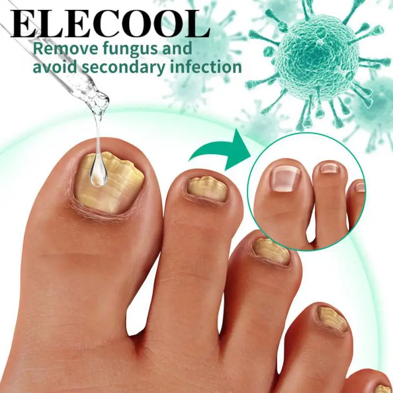 OUHOE Toenail Fungal Feet Care Nail Foot Whitening Toe Nail Repair Fungus Removal Gel Anti Paronychia Onychomycosis Feet Cares
OUHOE Toenail Fungal Feet Care Nail Foot Whitening Toe Nail Repair Fungus Removal Gel Anti Paronychia Onychomycosis Feet Cares