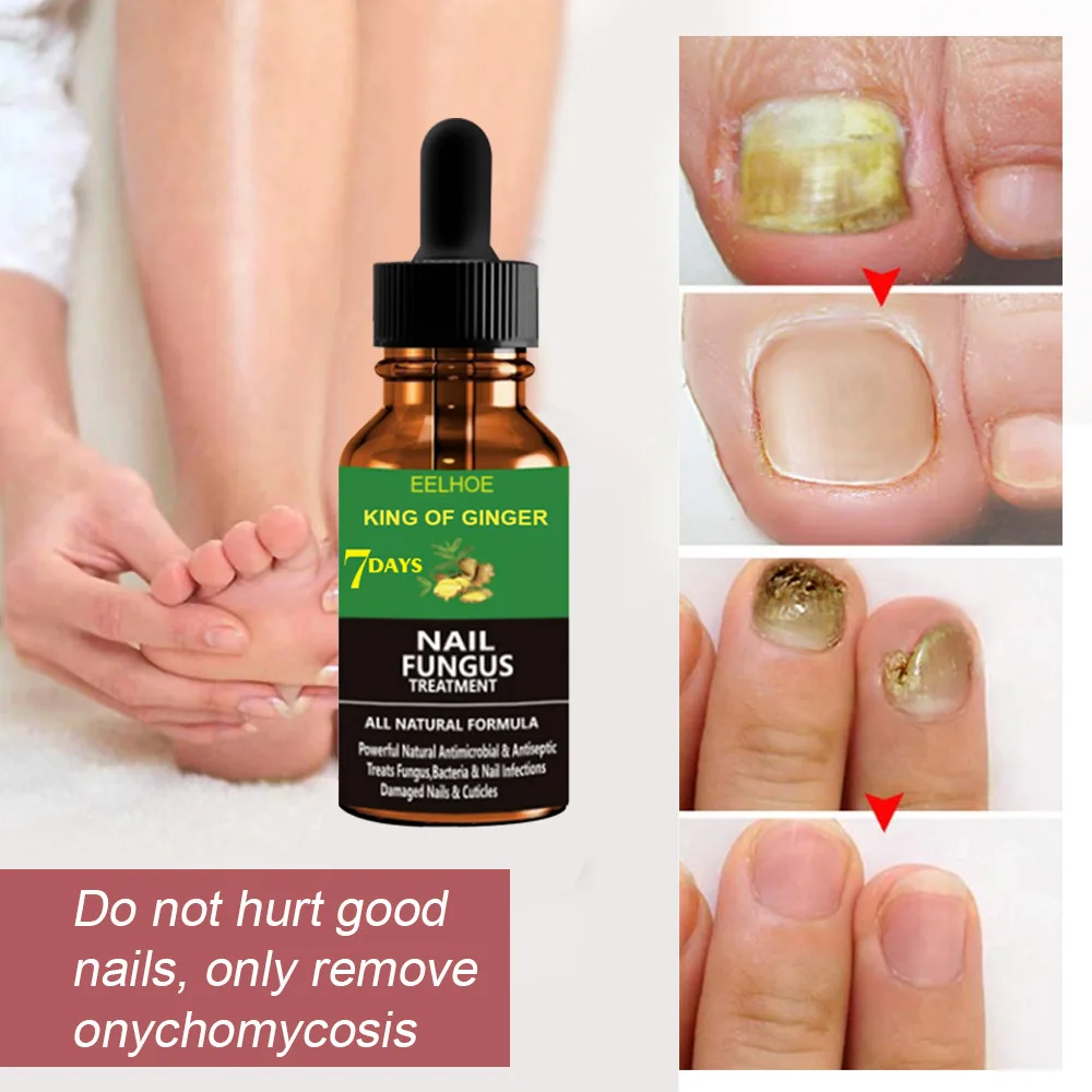 20/30/50ML Nail Fungal Treatment Feet Care Essence Foot Toe Nail Fungus Removal Serum Anti Infection Paronychia Onychomycosis
20/30/50ML Nail Fungal Treatment Feet Care Essence Foot Toe Nail Fungus Removal Serum Anti Infection Paronychia Onychomycosis