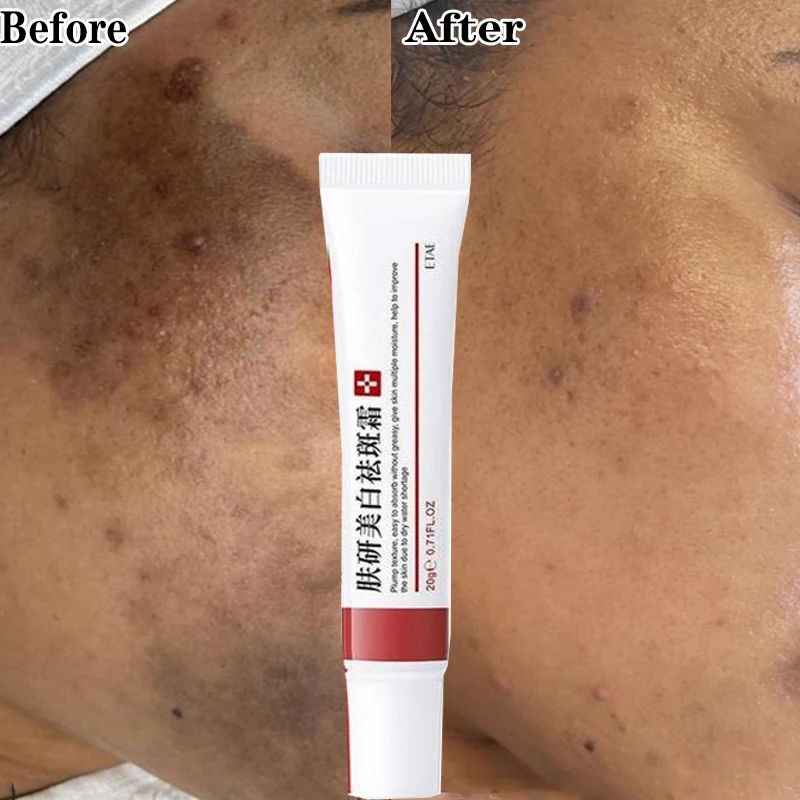 20ml Effective Freckle Cream Remove Dark Spots Witening Cream Fade Acne Scars Melanin Pigmentation Melasma Anti-Aging Skin Care
20ml Effective Freckle Cream Remove Dark Spots Witening Cream Fade Acne Scars Melanin Pigmentation Melasma Anti-Aging Skin Care