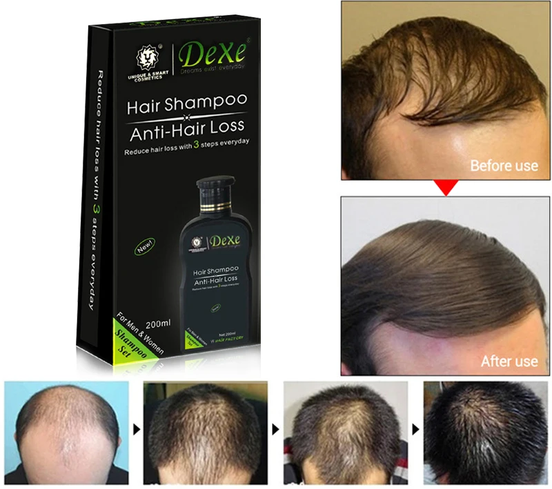 Professional hair growth Shampoo Anti-hair Loss Chinese Herbal Hair Growth Product Prevent Hair Treatment Free shipping 
Professional hair growth Shampoo Anti-hair Loss Chinese Herbal Hair Growth Product Prevent Hair Treatment Free shipping