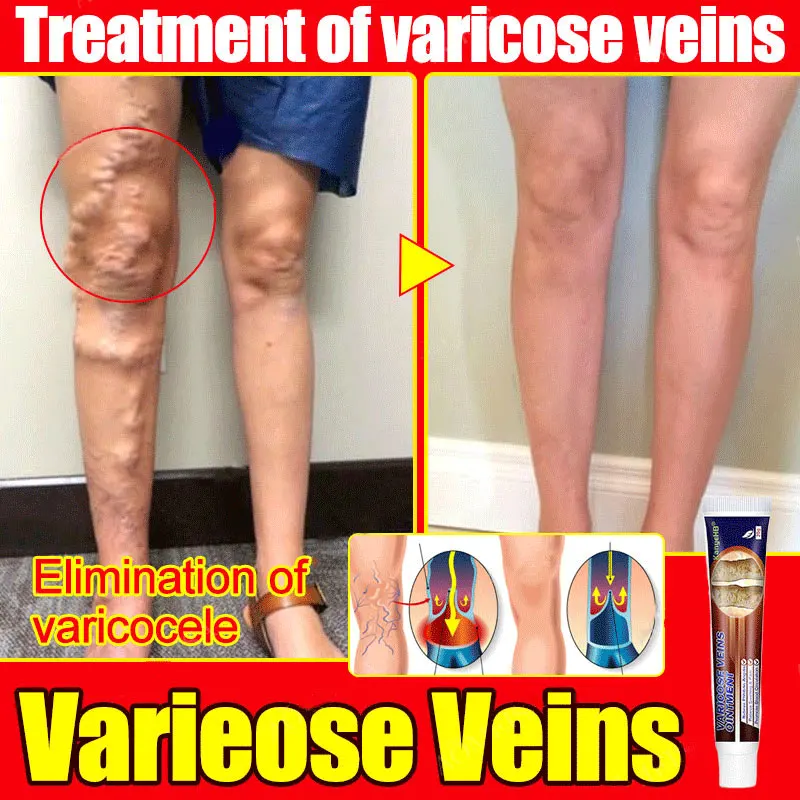 Effective Varicose Vein Relief Cream Ointment For Varicose Veins To Relieve Vasculitis Phlebitis Spider Pain Treatment feet
Effective Varicose Vein Relief Cream Ointment For Varicose Veins To Relieve Vasculitis Phlebitis Spider Pain Treatment feet