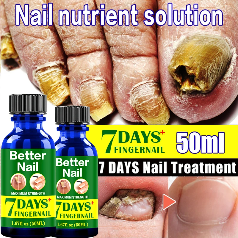 7-day fungal nail repair essence, treat toenail fungus, remove anti-paronychia, onychomycosis and anti-infection
7-day fungal nail repair essence, treat toenail fungus, remove anti-paronychia, onychomycosis and anti-infection