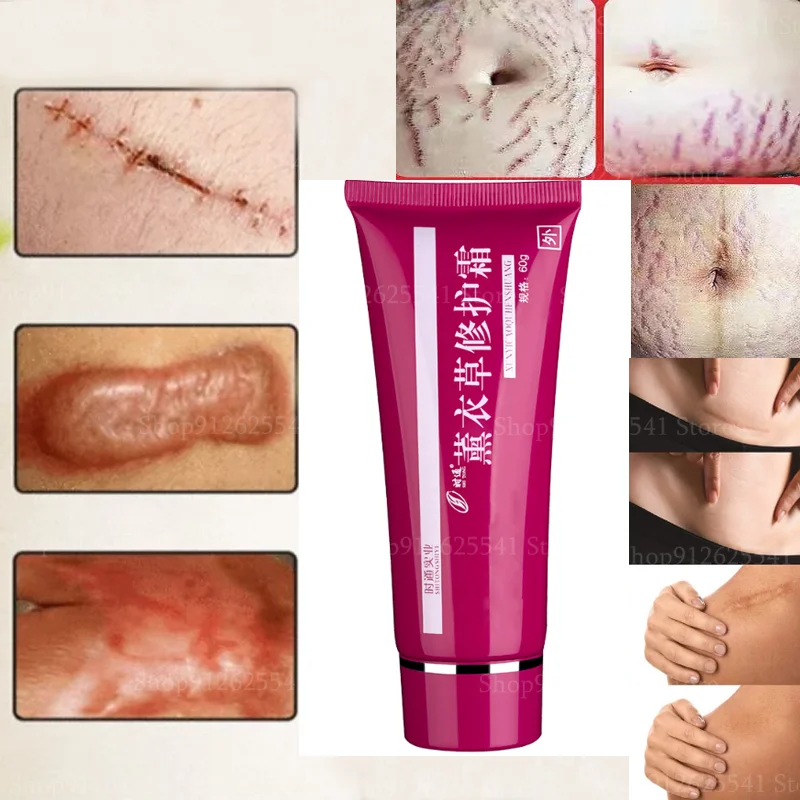 60g Removal Stretch Marks Cream Scar-removing Balance Gel Treatment Pimples Spots Repair Gel Whitening Moisturizer Skin Care
60g Removal Stretch Marks Cream Scar-removing Balance Gel Treatment Pimples Spots Repair Gel Whitening Moisturizer Skin Care