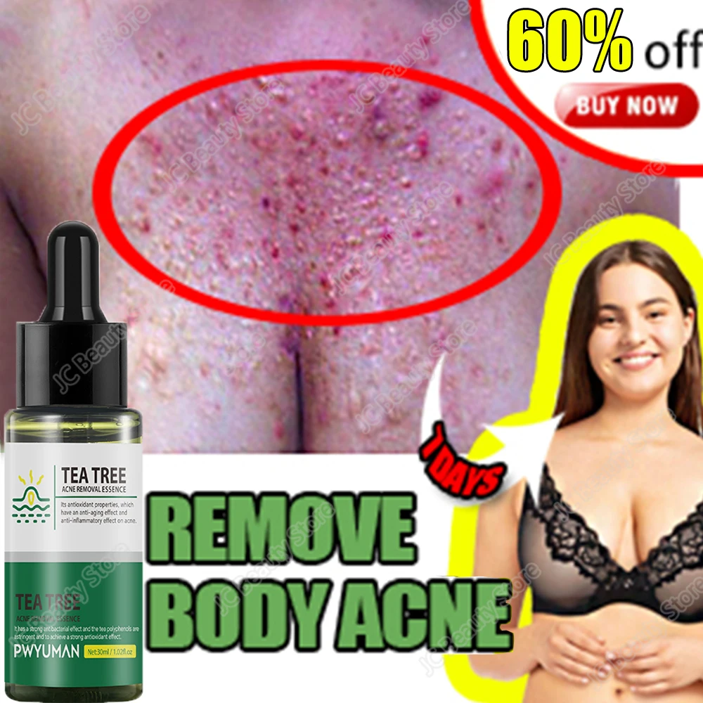 Tea Tree Oil Acne Treatment Serum Remove Blackhead Pimple Acne Scar Treatment Essence Cream Shrink Pores Skin Care Cosmetics
Tea Tree Oil Acne Treatment Serum Remove Blackhead Pimple Acne Scar Treatment Essence Cream Shrink Pores Skin Care Cosmetics